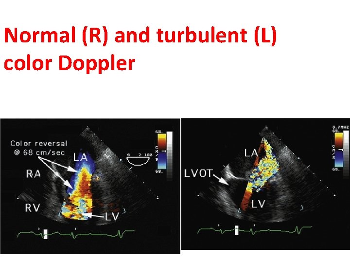 Normal (R) and turbulent (L) color Doppler 