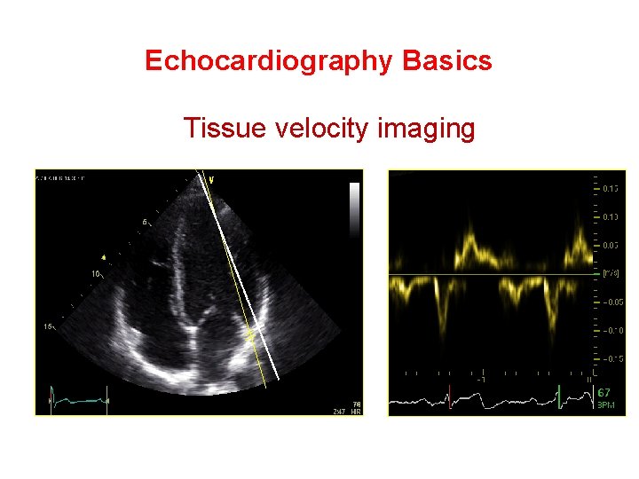 Echocardiography Basics Tissue velocity imaging 