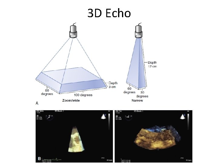 3 D Echo 