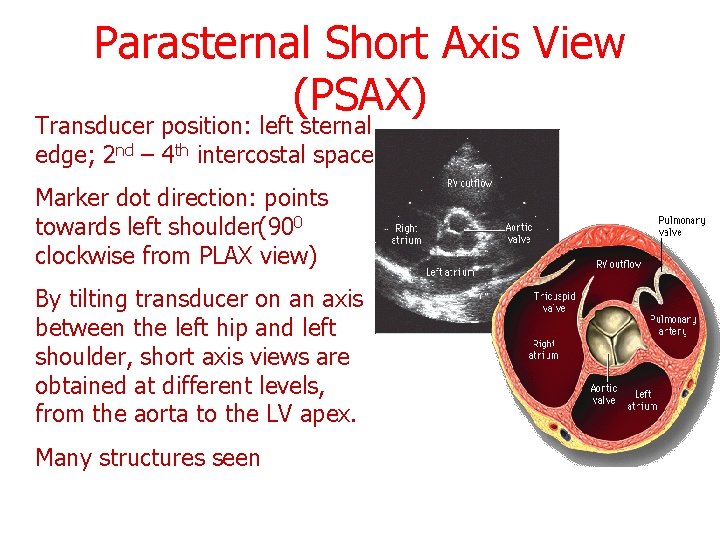 Parasternal Short Axis View (PSAX) Transducer position: left sternal edge; 2 nd – 4