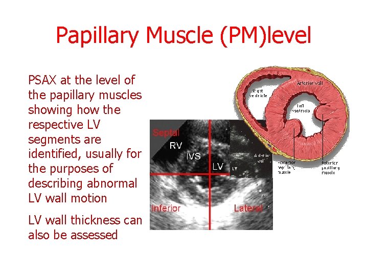 Papillary Muscle (PM)level PSAX at the level of the papillary muscles showing how the