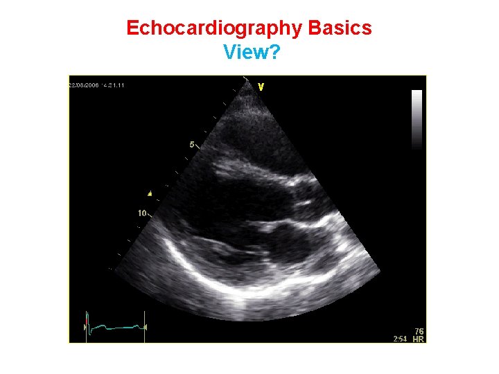 Echocardiography Basics View? 