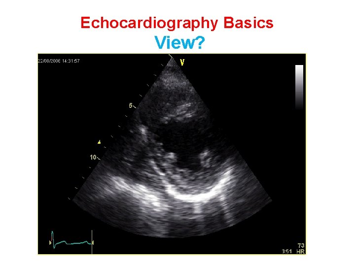 Echocardiography Basics View? 