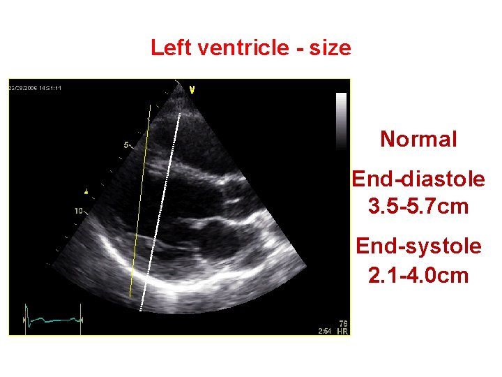 Left ventricle - size Normal End-diastole 3. 5 -5. 7 cm End-systole 2. 1