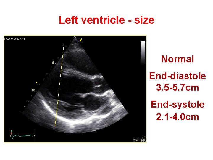 Left ventricle - size Normal End-diastole 3. 5 -5. 7 cm End-systole 2. 1