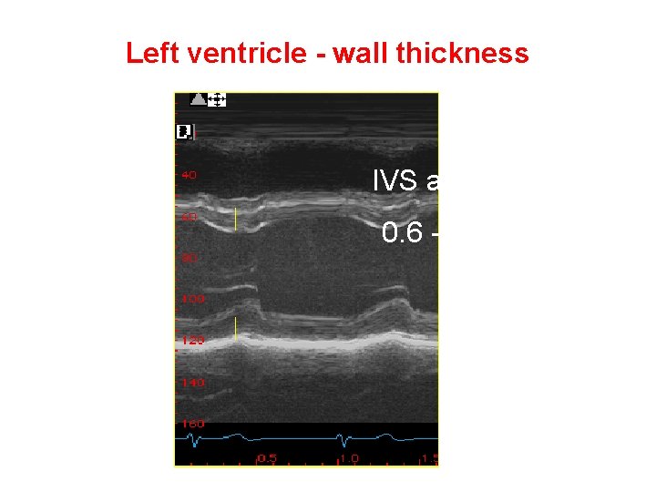 Left ventricle - wall thickness IVS and PW 0. 6 -1. 1 cm 