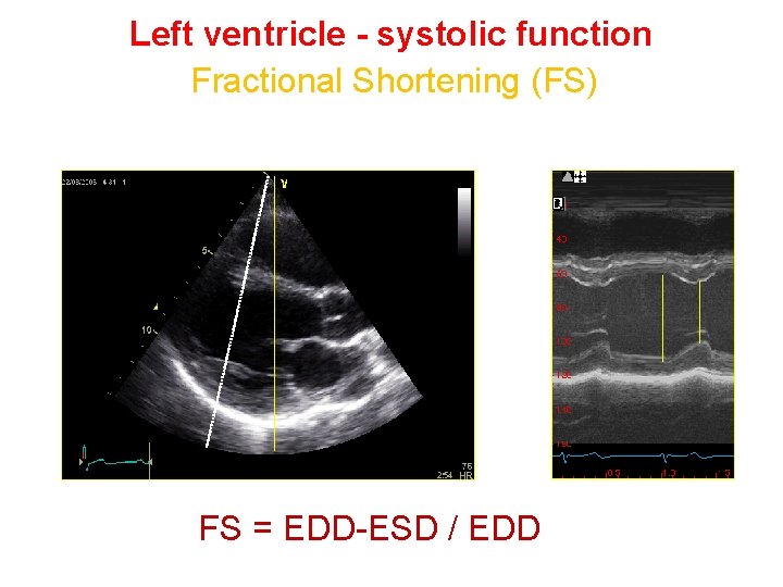 Left ventricle - systolic function Fractional Shortening (FS) FS = EDD-ESD / EDD 