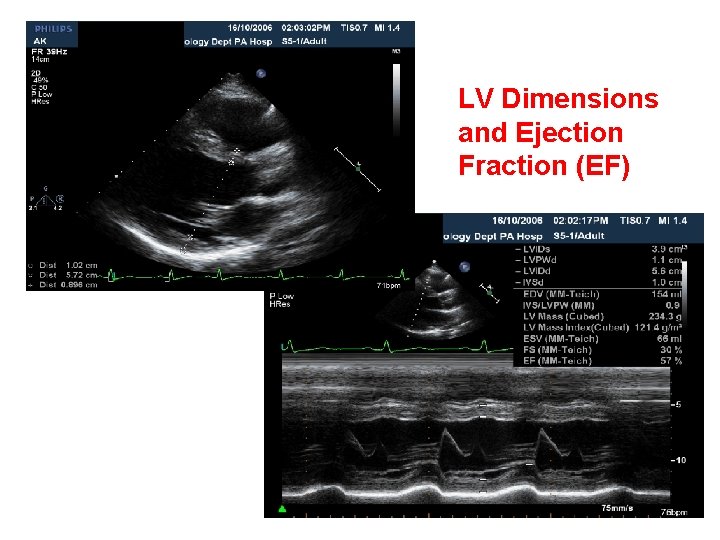 LV Dimensions and Ejection Fraction (EF) 