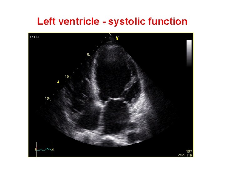 Left ventricle - systolic function 