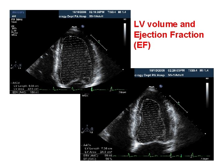 LV volume and Ejection Fraction (EF) 