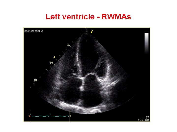 Left ventricle - RWMAs 