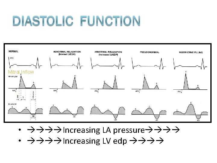 Mitral Inflow • Increasing LA pressure • Increasing LV edp 