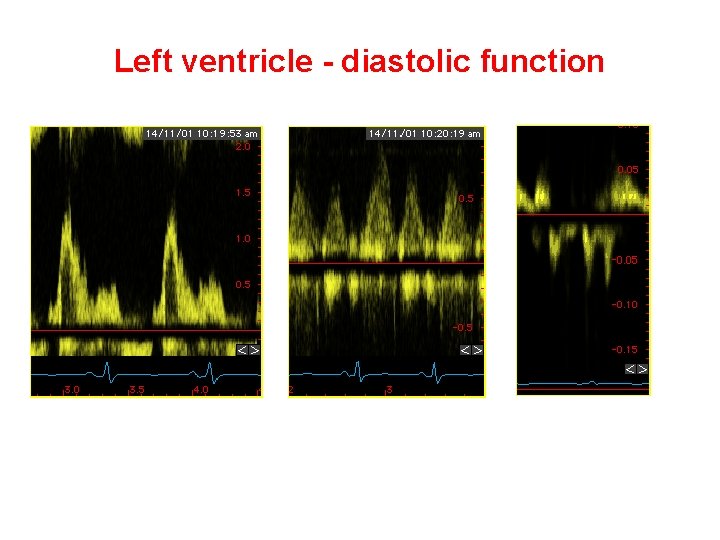 Left ventricle - diastolic function Mitral inflow Pulmonary veins Mitral TVI 