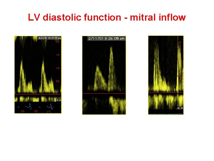 LV diastolic function - mitral inflow E/A > 1 E/A < 1 E/A >>1