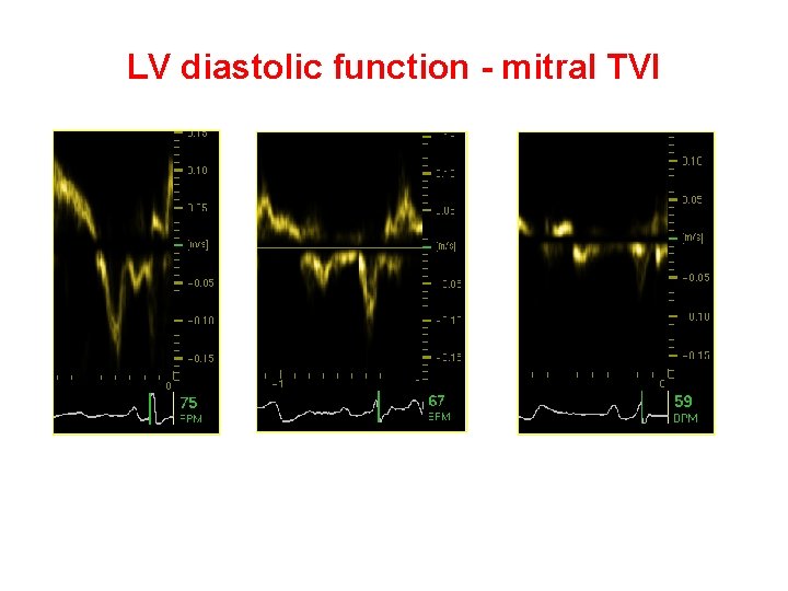 LV diastolic function - mitral TVI E/A > 1 E/A < 1 E/A >>1