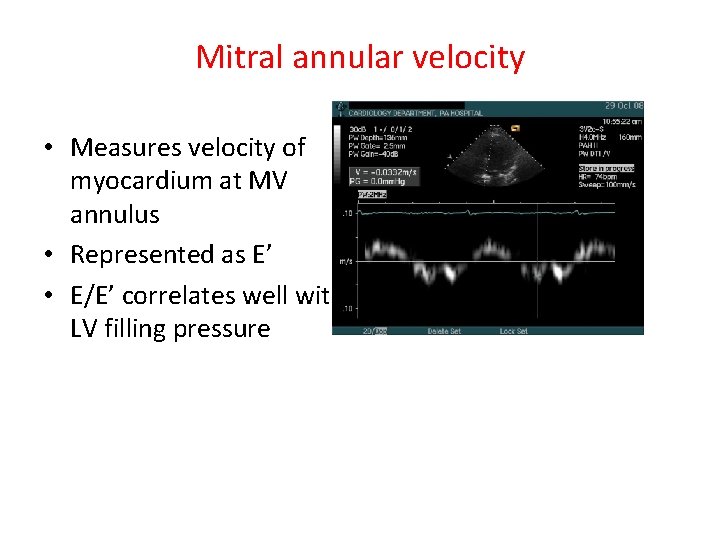 Mitral annular velocity • Measures velocity of myocardium at MV annulus • Represented as