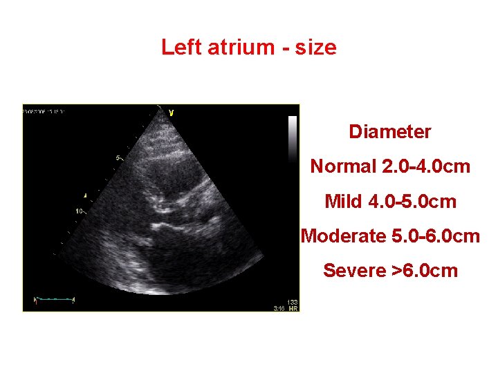 Left atrium - size Diameter Normal 2. 0 -4. 0 cm Mild 4. 0