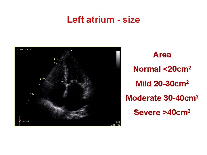 Left atrium - size Area Normal <20 cm 2 Mild 20 -30 cm 2