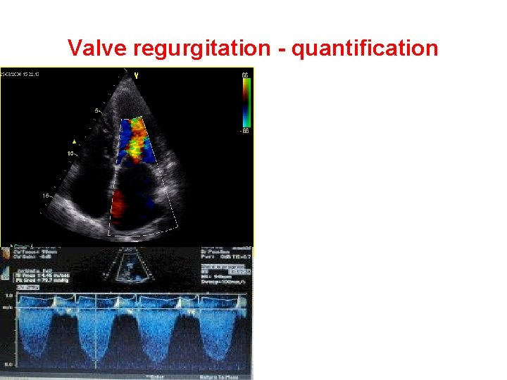 Valve regurgitation - quantification Colour - jet size/width PISA Spectral doppler Consequences 