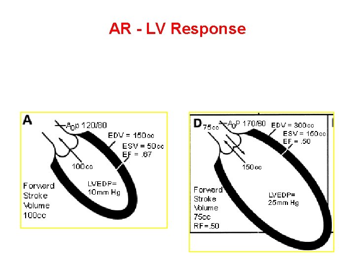 AR - LV Response • Chronic AR - decompensated LV • LVEF<55%, LVESD>55 mm,