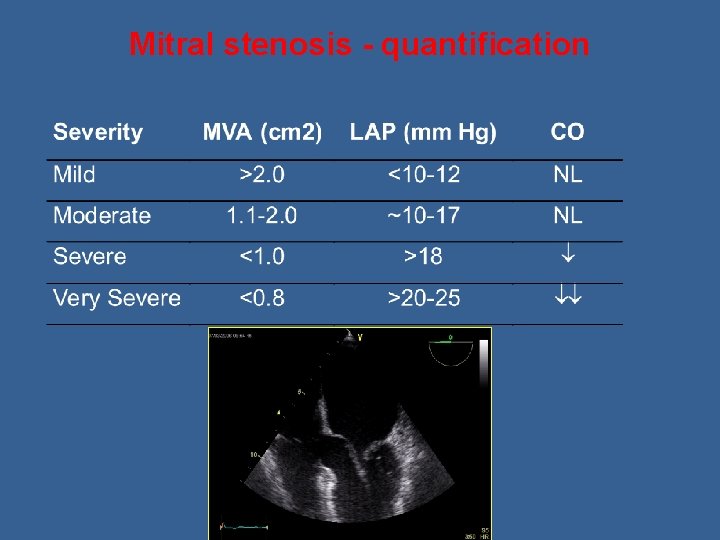 Mitral stenosis - quantification 