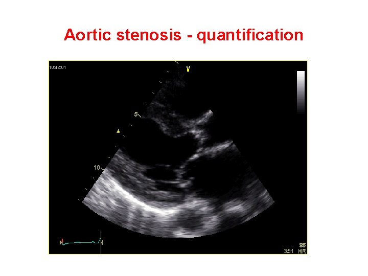 Aortic stenosis - quantification 