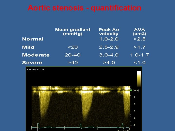Aortic stenosis - quantification 