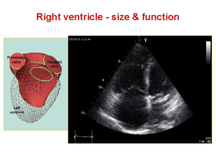 Right ventricle - size & function 