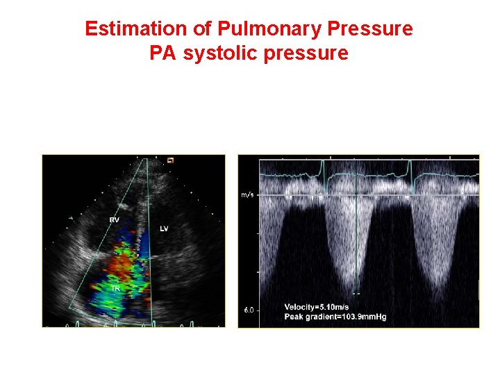 Estimation of Pulmonary Pressure PA systolic pressure • Tricuspid regurgitation jet velocity 