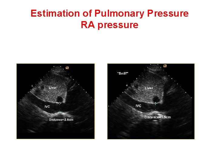 Estimation of Pulmonary Pressure RA pressure • IVC size 