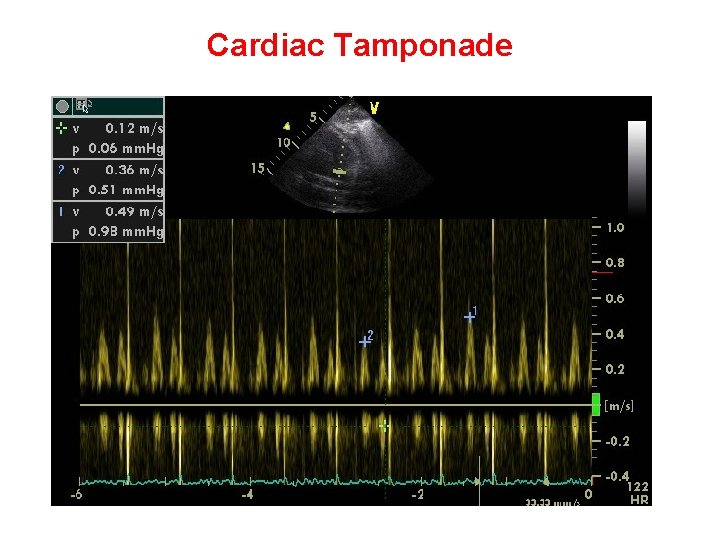 Cardiac Tamponade 