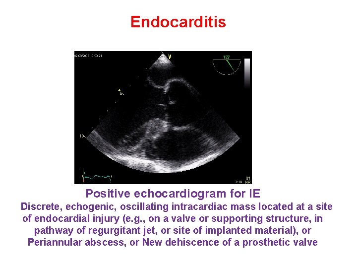 Endocarditis Positive echocardiogram for IE Discrete, echogenic, oscillating intracardiac mass located at a site