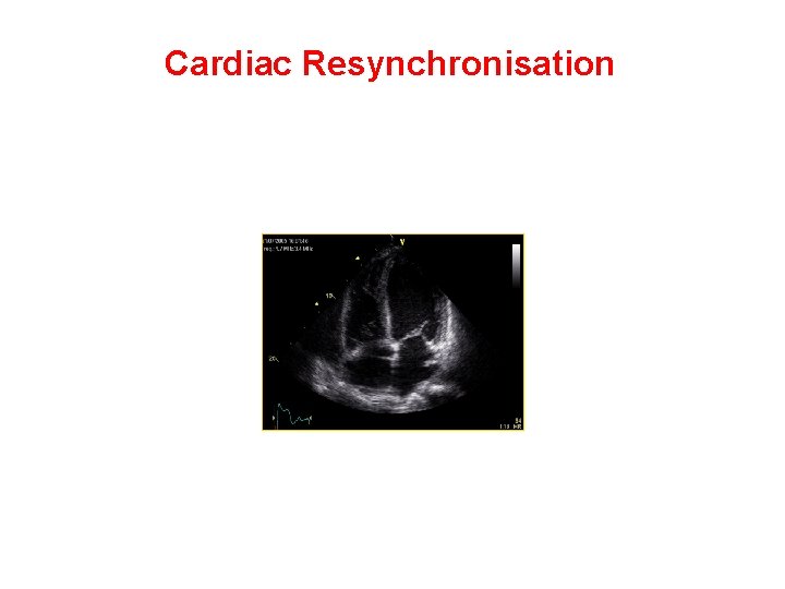 Cardiac Resynchronisation 