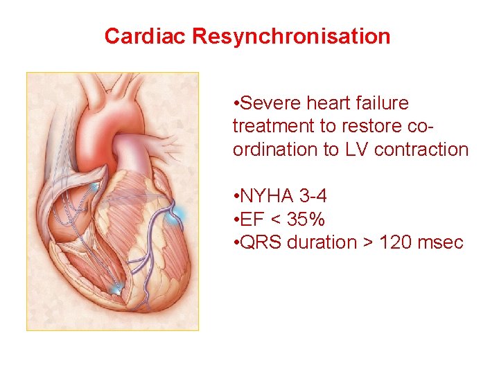 Cardiac Resynchronisation • Severe heart failure treatment to restore coordination to LV contraction •