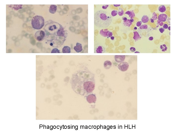 Phagocytosing macrophages in HLH 