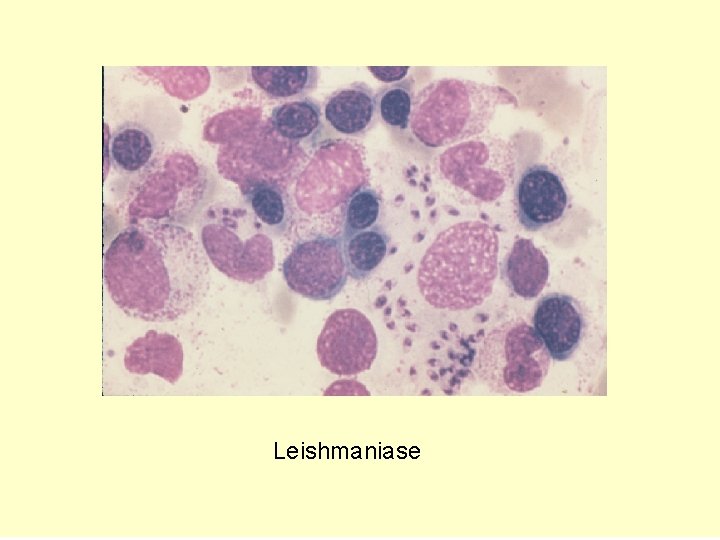 Leishmaniase 