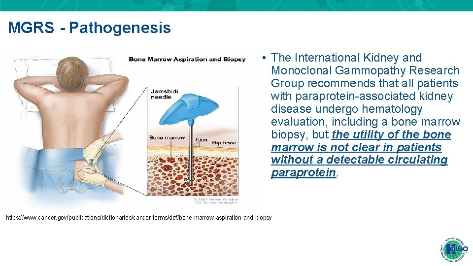 MGRS - Pathogenesis • The International Kidney and Monoclonal Gammopathy Research Group recommends that
