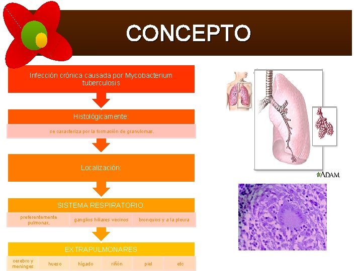 CONCEPTO Infección crónica causada por Mycobacterium tuberculosis Histológicamente: se caracteriza por la formación de