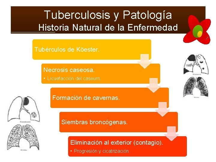 Tuberculosis y Patología Historia Natural de la Enfermedad Tubérculos de Köester. Necrosis caseosa. •