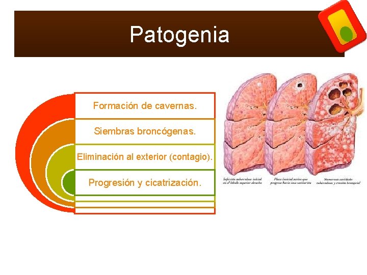 Patogenia Formación de cavernas. Siembras broncógenas. Eliminación al exterior (contagio). Progresión y cicatrización. 