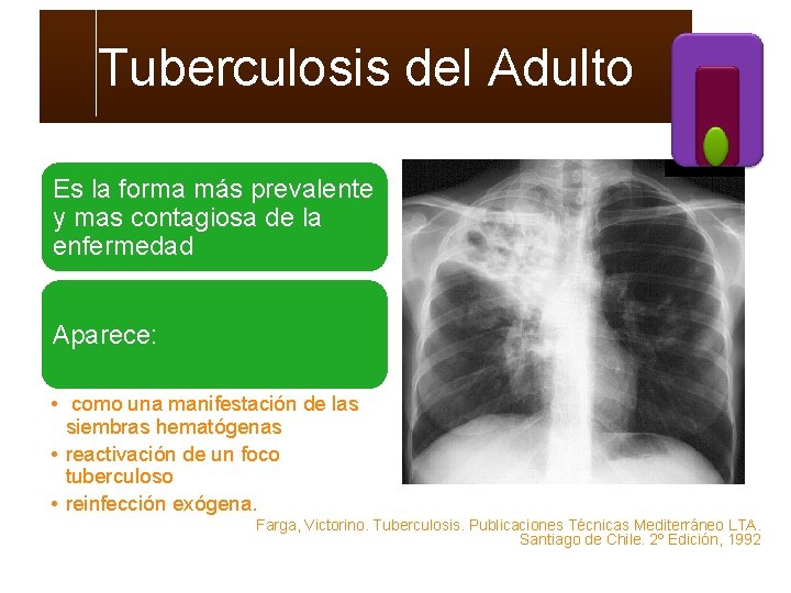 Tuberculosis del Adulto Es la forma más prevalente y mas contagiosa de la enfermedad