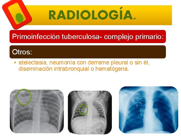 RADIOLOGÍA. Primoinfección tuberculosa- complejo primario: Otros: • atelectasia, neumonía con derrame pleural o sin