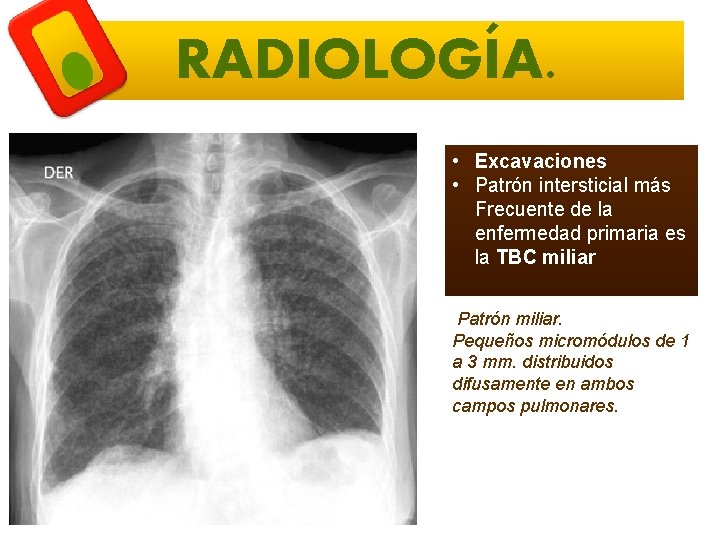 RADIOLOGÍA. • Excavaciones • Patrón intersticial más Frecuente de la enfermedad primaria es la