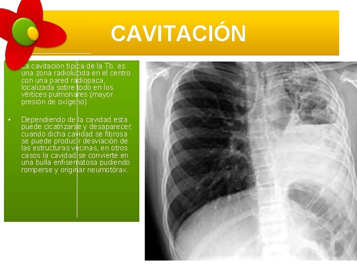 CAVITACIÓN • La cavitación típica de la Tb. es una zona radiolúcida en el