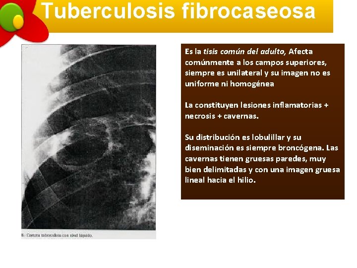 Tuberculosis fibrocaseosa Es la tisis común del adulto, Afecta comúnmente a los campos superiores,