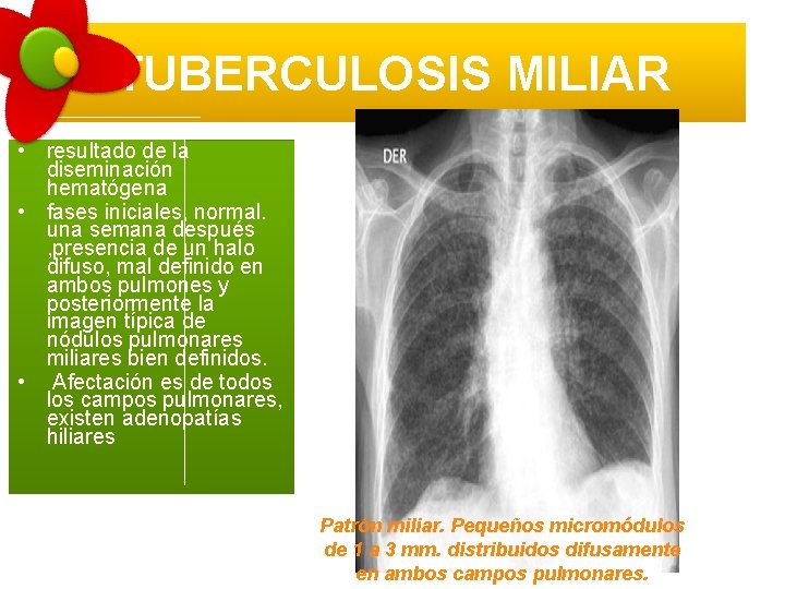 TUBERCULOSIS MILIAR • resultado de la diseminación hematógena • fases iniciales, normal. una semana