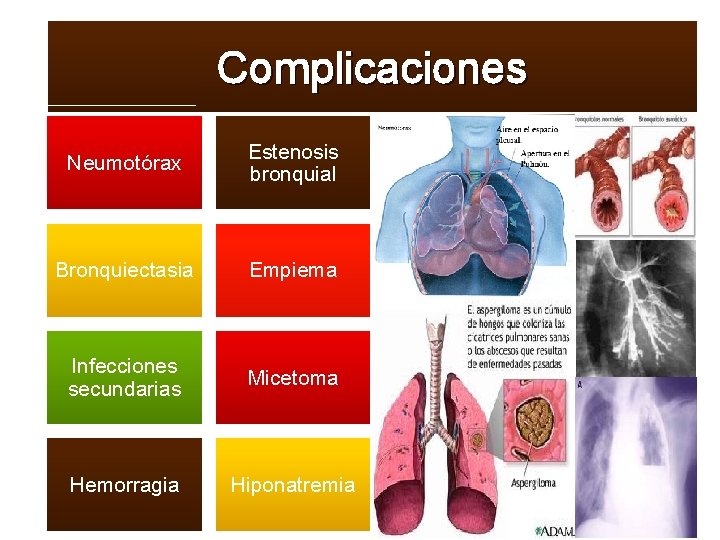 Complicaciones Neumotórax Estenosis bronquial Bronquiectasia Empiema Infecciones secundarias Micetoma Hemorragia Hiponatremia 