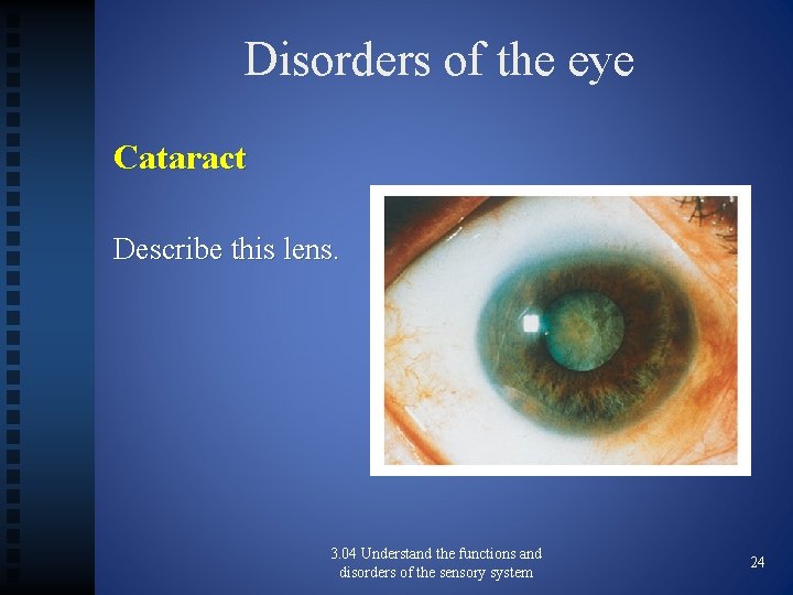 Disorders of the eye Cataract Describe this lens. 3. 04 Understand the functions and