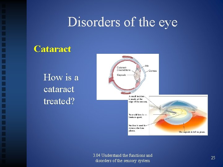 Disorders of the eye Cataract How is a cataract treated? 3. 04 Understand the