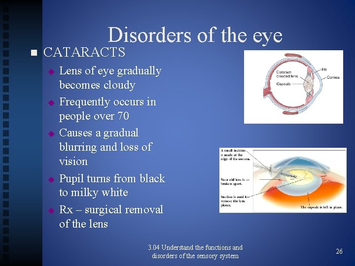 Disorders of the eye n CATARACTS u u u Lens of eye gradually becomes